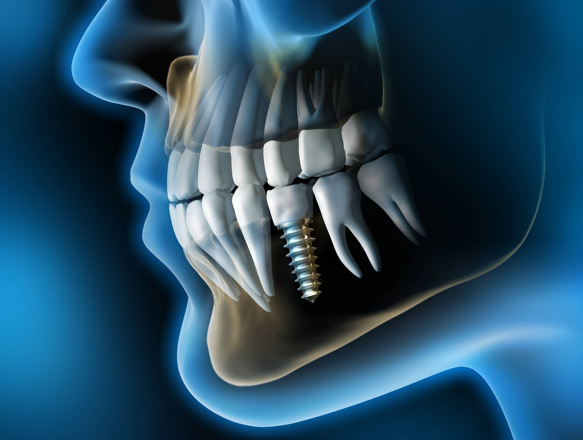 Imagerie dentaire 3D